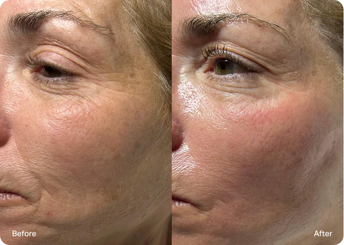 Fine lines and wrinkles appearance comparison